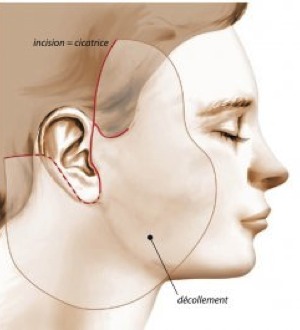 lifting facial tournai