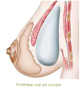 prothèse seins Tournai