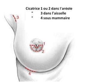incision augmentation mammaire