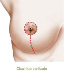 mastopexie cicatrice verticale