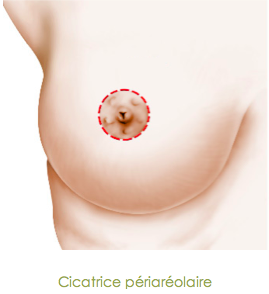 mastopexie cicatrice