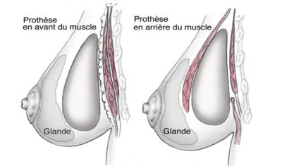 implantation mammaire