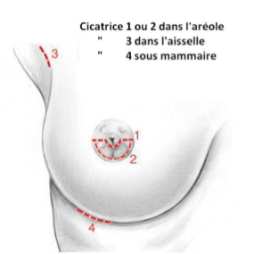 augmentation mammaire