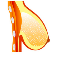 ptose mammaire