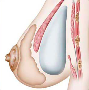 reconstruction mammaire prothèse simple