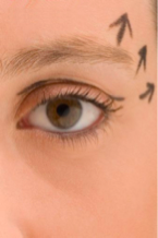 blepharoplastie tournai 3