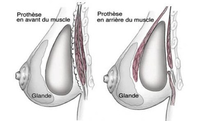 augmentation mammaire dr. carpentier