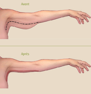brachioplastie tournai
