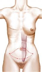 reconstruction mammaire grand droit abdominal tournai