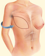 reconstruction mammaire tournai