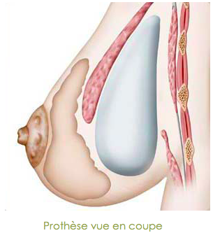 reconstruction mammaire prothèse simple tournai
