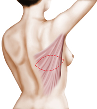 reconstruction des seins ramegnies-chin